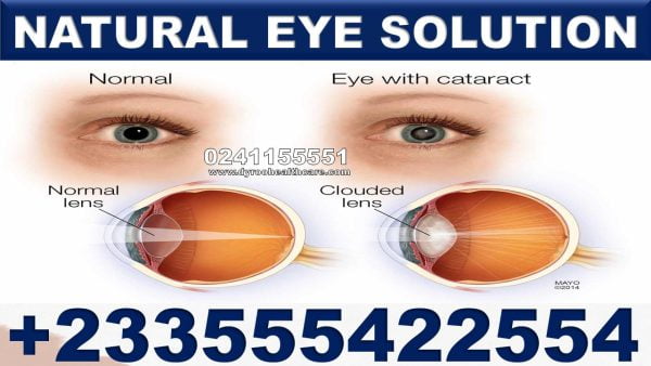 Herbal Remedies for Cataract in Ghana