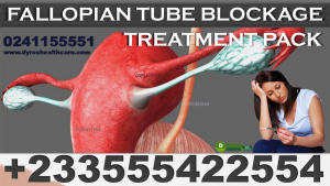 Natural Solution for Fallopian Tubes Blockage in Ghana