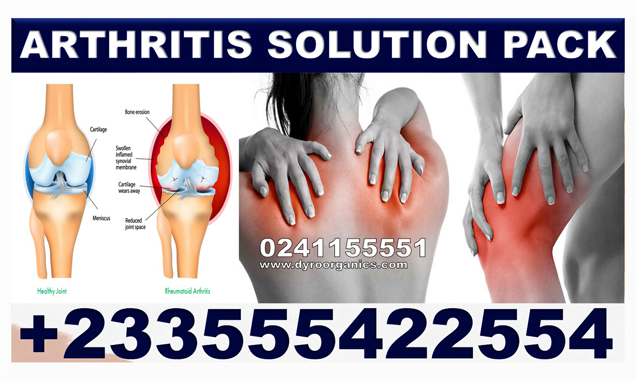 Aloe Vera Supplement for Arthritis in Ghana