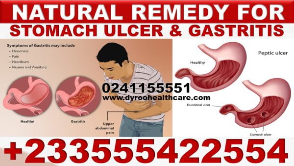 Gastrointestinal Ulcer Pills in Ghana