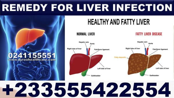 Fatty Liver Supplements in Ghana