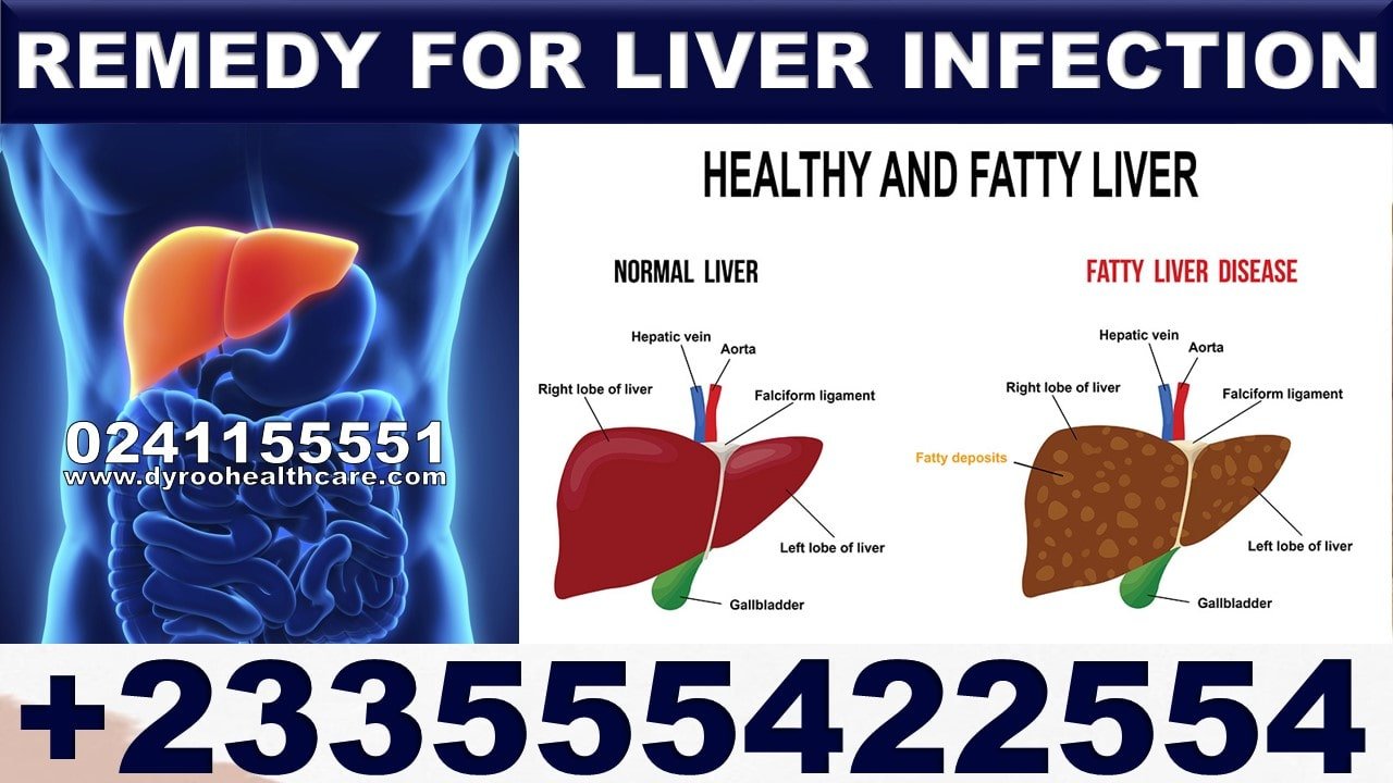 Fatty Liver Supplements in Ghana